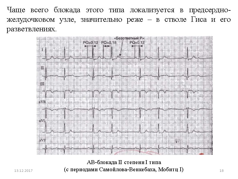 13.12.2017 18 Чаще всего блокада этого типа локализуется в предсердно-желудочковом узле, значительно реже –